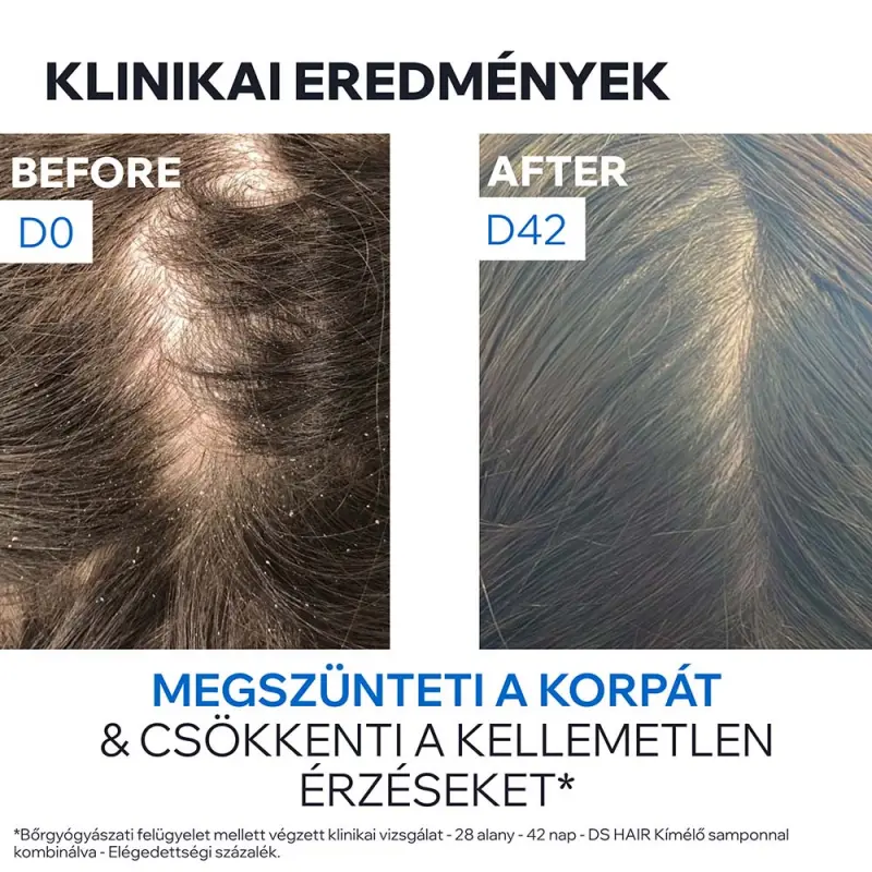 D.S. HAIR Sampon korpás fejbőrre 200 ml