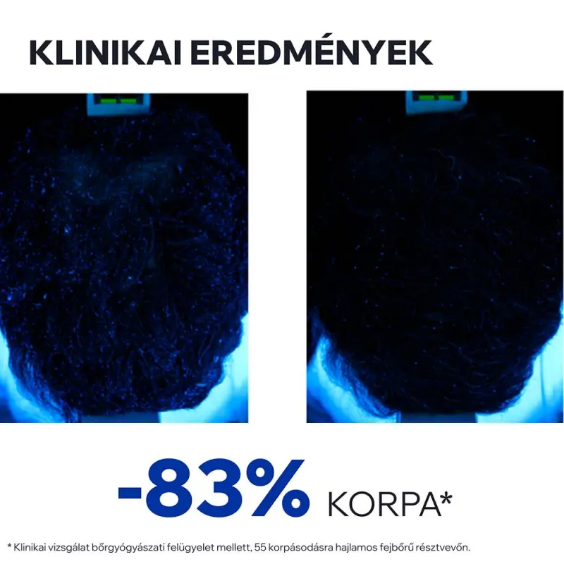 D.S. Lotion spray korpás fejbőrre 100 ml