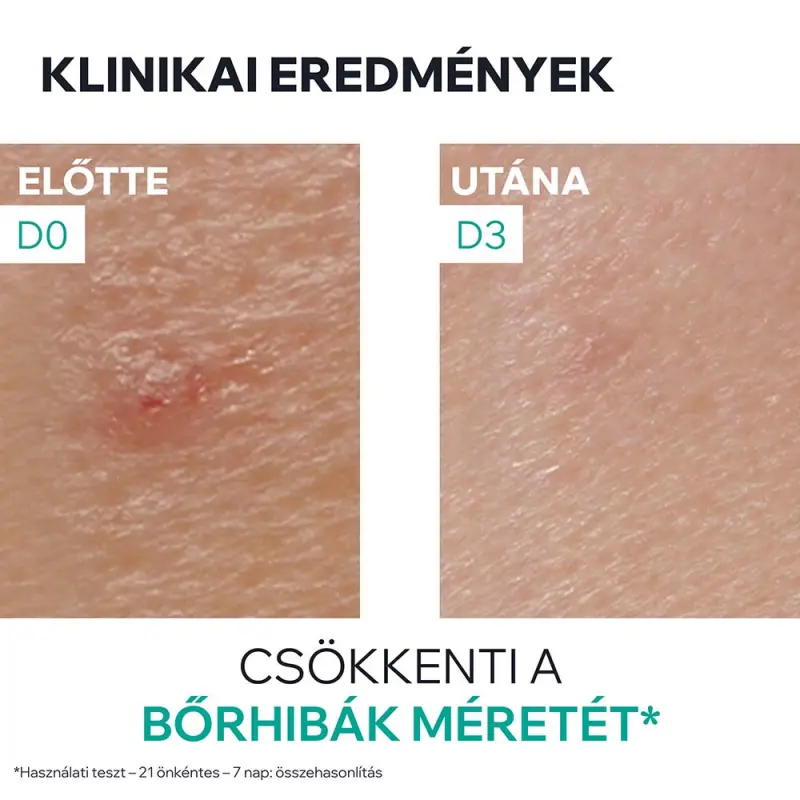HYSÉAC SOS PATÉ - Pattanások SOS kezelésére, éjszakára 15 g
